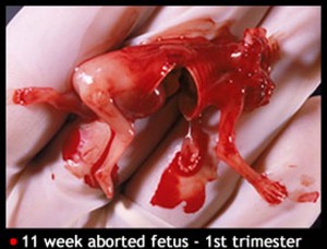 11 Week Aborted Fetus
