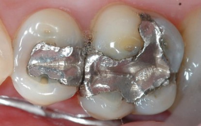 FDA’s Proposal to Curb Mercury Fillings Was Secretly Overruled by Senior Government Officials