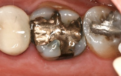 Dental fillings with mercury can cause over 30 chronic health conditions