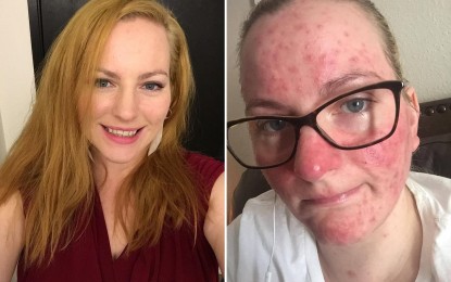Mother claims: Flu shot caused blindness and multiple sclerosis after being forced to vaccinate by her boss
